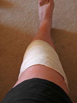 Bandaged knee after total knee replacement