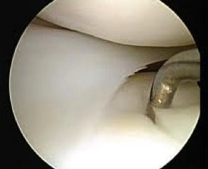 Arthroscopic view of the knee joint showing healthy articular cartilage and meniscus.